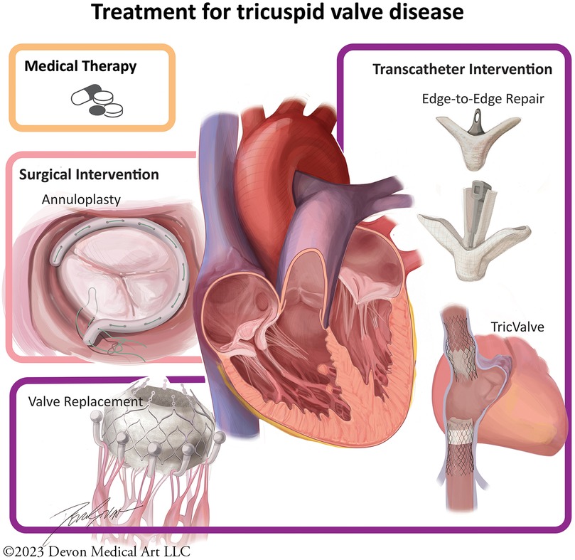 Contemporary evaluation and treatment of tricuspid regurgitation